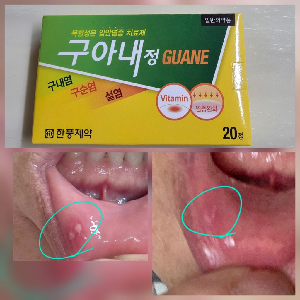 입안염증 치료제